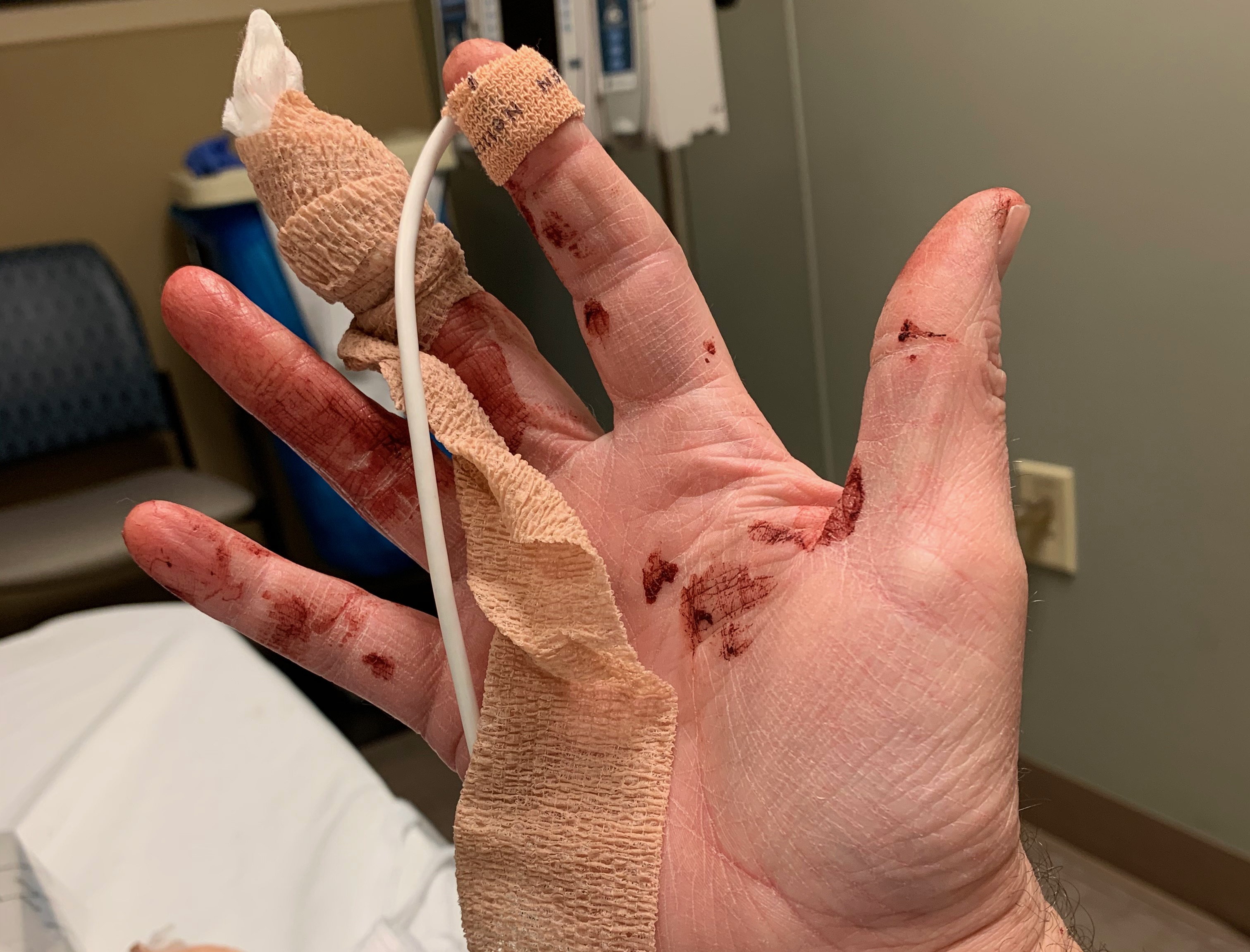 Finger Injury